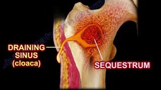 Pathology 825 f Pyogenic Osteomyelitis Pathogenesis Gross Involucrum Brodies abscess [upl. by Hannibal]