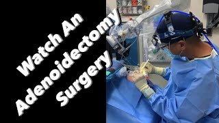 Adenoidectomy  actual footage [upl. by Affer]