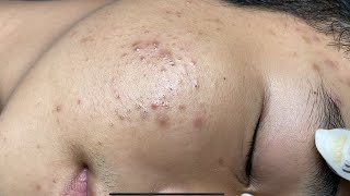 ACNE TREATMENT VU QUYNH MI Acne On Boys Chin 2024 [upl. by Toolis944]