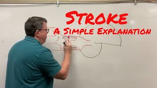 Stroke Cerebrovascular Accident A Simple Explanation [upl. by Suhpesoj]