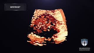 3DTHYROID® Thyroid Cancer Video Hard Nodule [upl. by Lleksah]