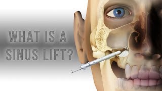 What is a sinus lift [upl. by Vaclava520]