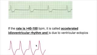 IDIOVENTRICULARACCELERATED IDIOVENTRICULAR RHYTHM [upl. by Eilasor38]