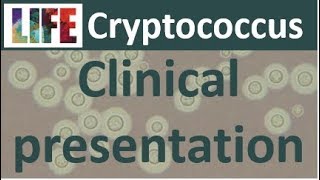 Cryptococcosis clinical presentation [upl. by Caddric845]