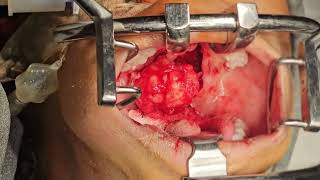 የላንቃ እጢpleomorphic adenoma እንዴት እንደርሰራሁት ላሳያችሁ [upl. by Jerrome630]