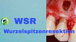 Die Wurzelspitzenresektion  WSR  retrograde Wurzelfüllung Schnittführung Zahnerhaltung [upl. by Willey893]