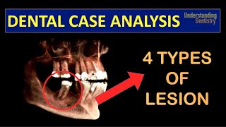 TRY TO DIAGNOSE A Case with 4 TYPES of PERIAPICAL LESIONS radicular cyst close to IAN Dental Quiz [upl. by Bayless854]