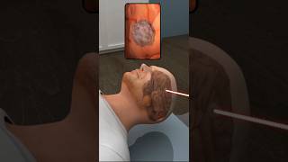 How To Brain Tumor Is Treated  3D Animation  shorts shortvideo [upl. by Aicrag856]