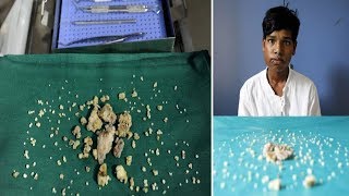 Indian Teen Ashik Gavai Has 232 Teeth Removed In 7 Hours Operation [upl. by Henden]