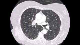 Spiculated lung tumor in background of emphysema [upl. by Mccully998]