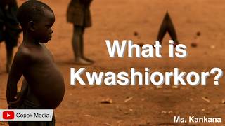 What is Kwashiorkor disease  Medical Science  General Medicine [upl. by Trawets28]