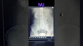 Intra venous urogram  pyelogram  radiological xray medicalimaging doctor anatomy [upl. by Liza48]