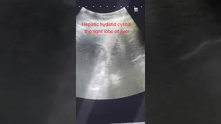 Hepatic hydatid cyst in the Right Lobe of Liver [upl. by Naahs873]