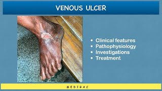 Venous Ulcer  Clinical features  Pathophysiology  Investigations  Treatment [upl. by Morentz176]