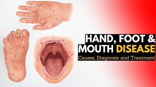 Hand Foot and Mouth Disease Causes Signs and Symptoms Diagnosis and Treatment [upl. by Enilekaj590]