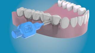 Clean the sides of your dental implants with a TePe Interdental Brush [upl. by Llenoil]