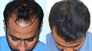 Hair Transplant Results USA Canada UAE  Medispa India JaipurDelhi by Dr Suneet Soni [upl. by Aitnahc30]