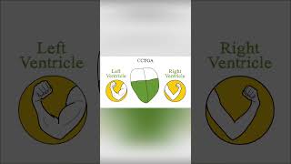 Congenitally corrected transposition of the great arteries CCTGA [upl. by Llerroj]