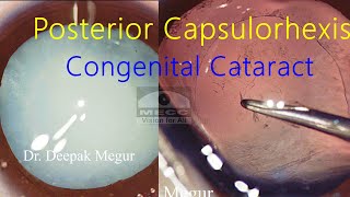 Posterior Capsulorhexis in a case of Congenital Cataract with Nystagmus [upl. by Amocat]