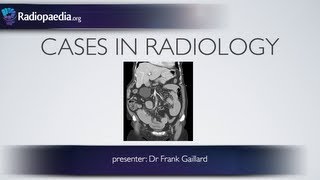 Cases in Radiology Episode 2 abdomen CT [upl. by Scevo]