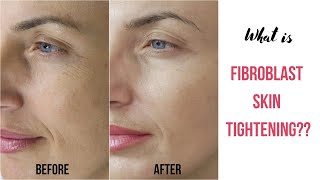 What is Fibroblast Skin Tightening [upl. by Templas]