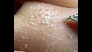 blackheads removal using nipper is so satisfying [upl. by Karmen]