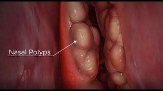 Nasal Polyps diagnosis and treatment options [upl. by Ardnovahs264]