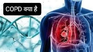 COPD होने पर फेफड़ो🫁 मे क्या दिकत आती है इसके बचाव क्या है Pharmadoctor subscribe health like [upl. by Akerue698]