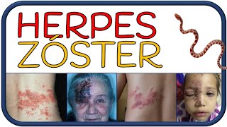 HERPES ZÓSTER  culebrilla síntomas herpes zóster oftálmico Sx RamseyHunt y complicaciones [upl. by Nala671]