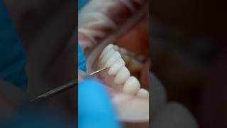 Get Perfect Teeth with Porcelain Veneers asmr dentalcosmeticturkey smilemakeover [upl. by Jaynell]