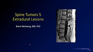 Spine tumors 5 – Extradural Lesions [upl. by Nine245]