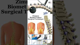 Zimmer Biomet Tether Surgical Technique medical animation 3d short [upl. by Enairb571]