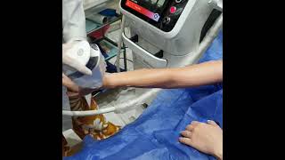 Advanced high speed laser hair removal using the Germanmade Mediostar machine [upl. by Ocirema]