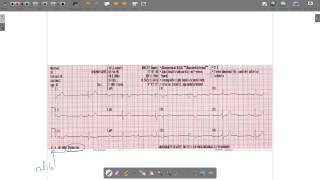 ECG Paper [upl. by Einreb]