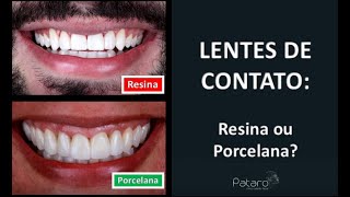 Lentes de Contato RESINA ou PORCELANA [upl. by Airtemak522]