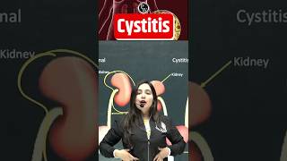 Cystitis Kya Hota Hai   पेशाब की थैली में सूजन  Cystitis ShortsFeed Cystitis Science PW [upl. by Fanny]