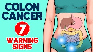 7 Warning Signs of Colon Cancer in 2024 [upl. by Latoyia]