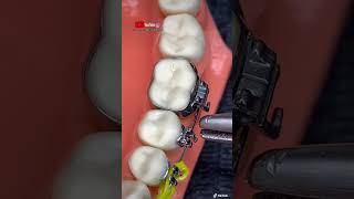 “Técnica para instalar separadores dentales y bandas metálicas en las muelas 🦷” [upl. by Akiemehs]