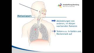 Kurz erklärt Metastasen [upl. by Aikenahs966]