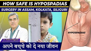 Safest Hypospadias Surgery in Kolkata Assam and Siliguri  Hypospadias Surgery [upl. by Munster251]