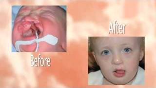 Cleft Lip and Palate Fort Wayne IN  Call 260 489 0099 [upl. by Noit]