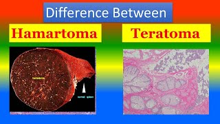 Difference between Hamartoma and Teratoma [upl. by Noired]