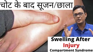 Swelling After Injury  चोट के बाद सूजनछाला   चोट की सूजन  COMPARTMENT SYNDROME [upl. by Yelrebmyk351]