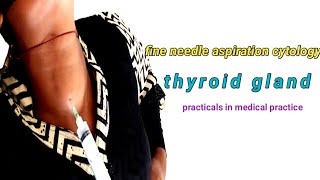 FNAC in the Diagnosis of Thyroid Gland [upl. by Range]