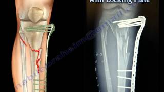 External Fixation With Locking Plate  Everything You Need To Know  Dr Nabil Ebraheim [upl. by Daitzman]