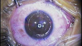 Dr Archie Agahan LASEK Laser epithelial keratomileusis refractive surgery [upl. by Anyahs226]