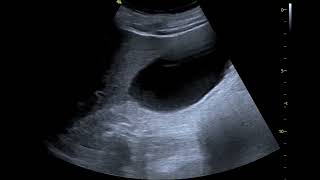 pleural effusion in CKD patient [upl. by Sam]