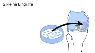 Behandlung Knorpelschaden by ATOS Kliniken [upl. by Clerk]