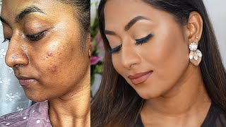 HOW TO COVER ACNE PRONE SKIN amp HYPERPIGMENTATION ✨  Flawless Full Coverage Base [upl. by Noonan]