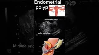 Endometrial Polyp Case Study A StepbyStep Diagnosis health ultrasound polyp DrSaimakhan [upl. by Meier]